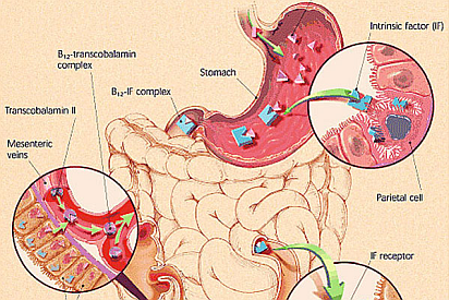 image of gastric cancer and pernicious anemia 