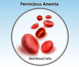 image of pernicious anemia red blood cells