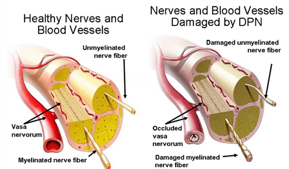 Diabetic Peripheral Neuropathy Healthy-Damaged