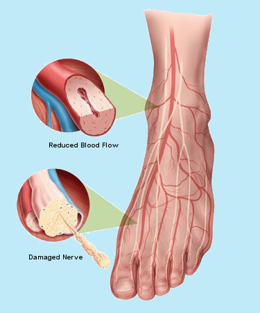 Foot Reduced Blood Flow 2. damaged nerve