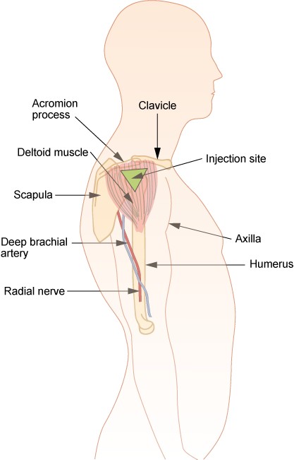Intramuscular Injection location, arm deltoid