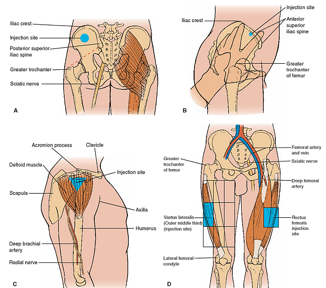 Intramuscular injection sites