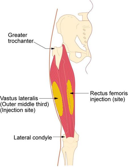 Intramuscular Injection location, leg, thigh