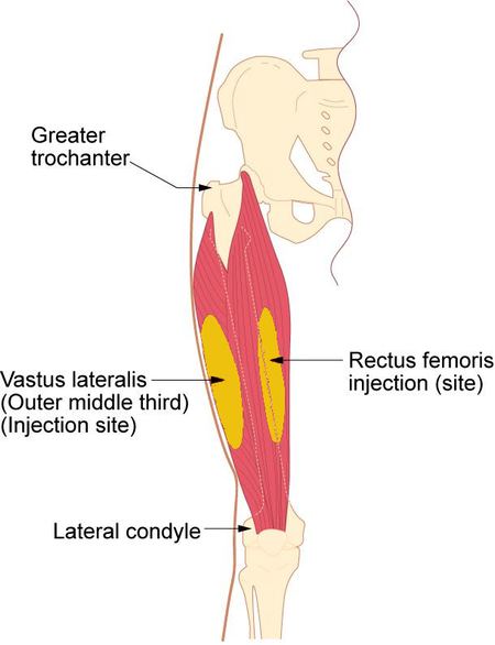 de inyección intramuscular de vitamina B12 - muslo