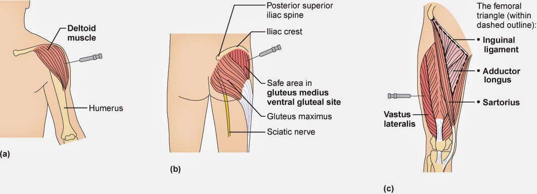 Intramuscular Injection Sites 3 Up