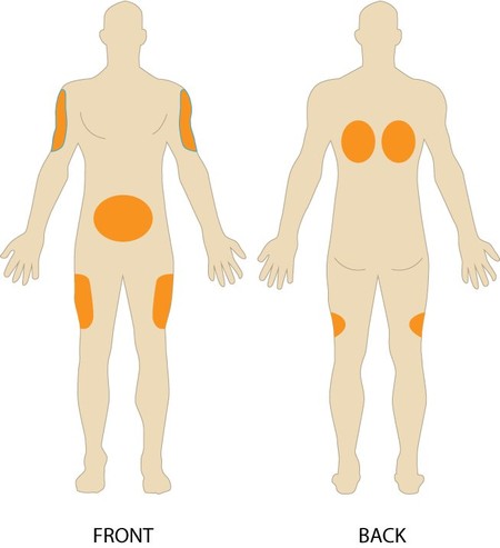 SUBCUTANEOUS INJECTION SITES WEB