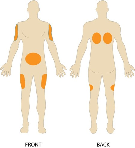 Subcutaneous Injection Sites