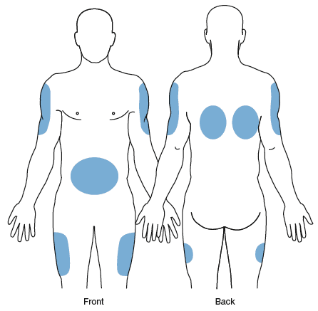 subcutaneous injection sites