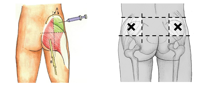 intramuscular injection glute, buttocks area