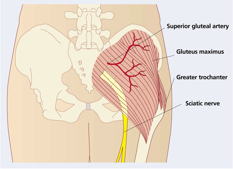 intramuscular injetion buttocks, glutamus maximus